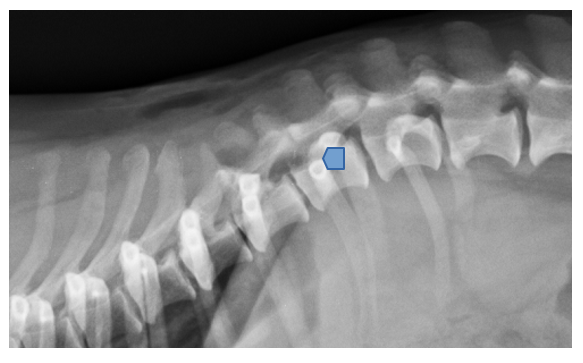 extrusión discal