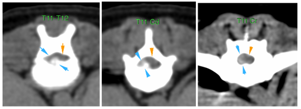 extrusión discal